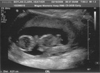 Abigail's Ultrasound